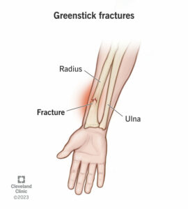 greenstick fractures