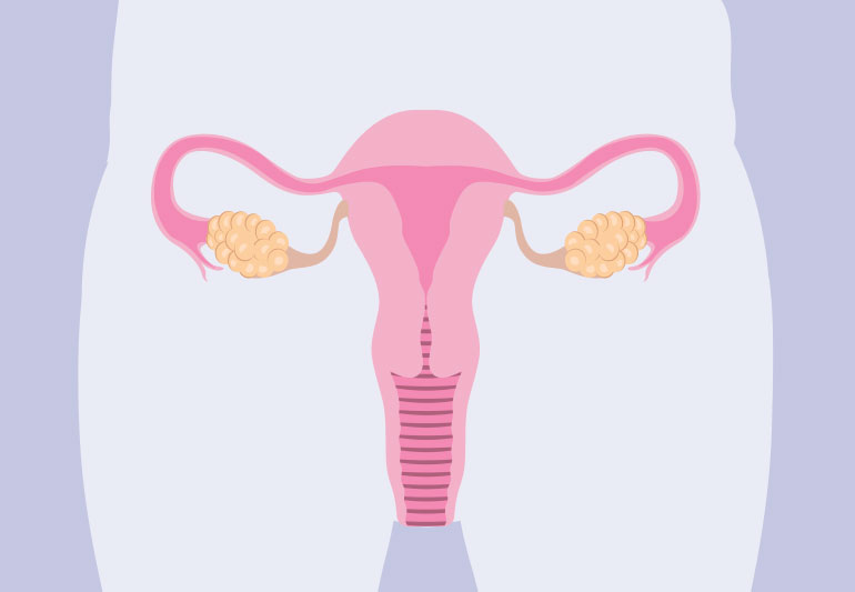 pcos uterusOvaries 1169701391 770x533 1