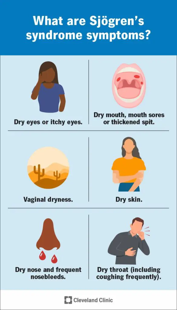 sjogrens syndrome infographic