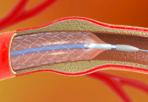 stentAngioplasty 1136631791 770x553 1