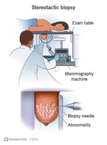 stereotactic biopsy