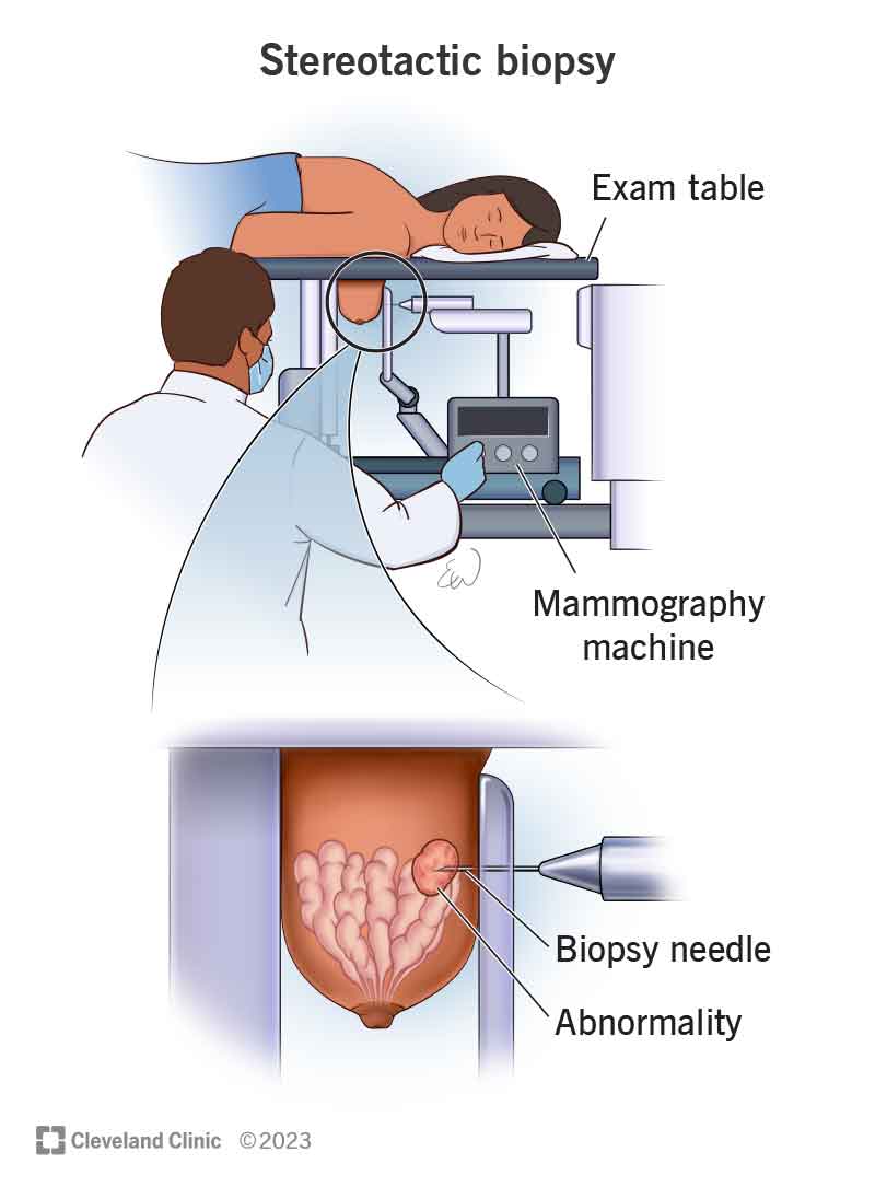 Persona, kas guļ uz galda stereotaktiskās biopsijas un biopsijas adatas tuvplāna laikā, noņemot audus no audzēja.