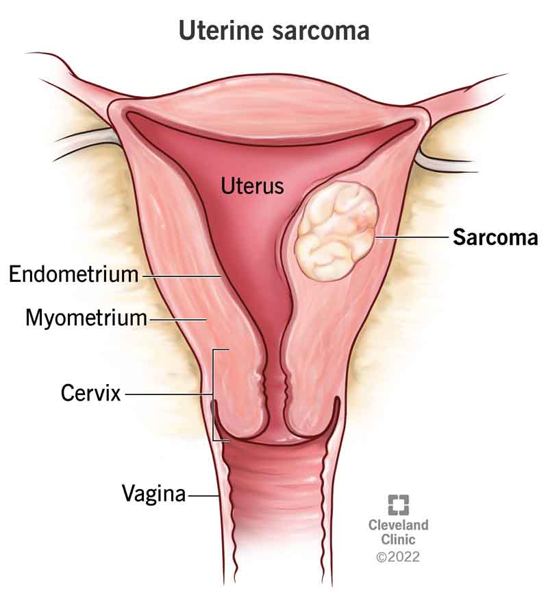 16408 uterine sarcoma