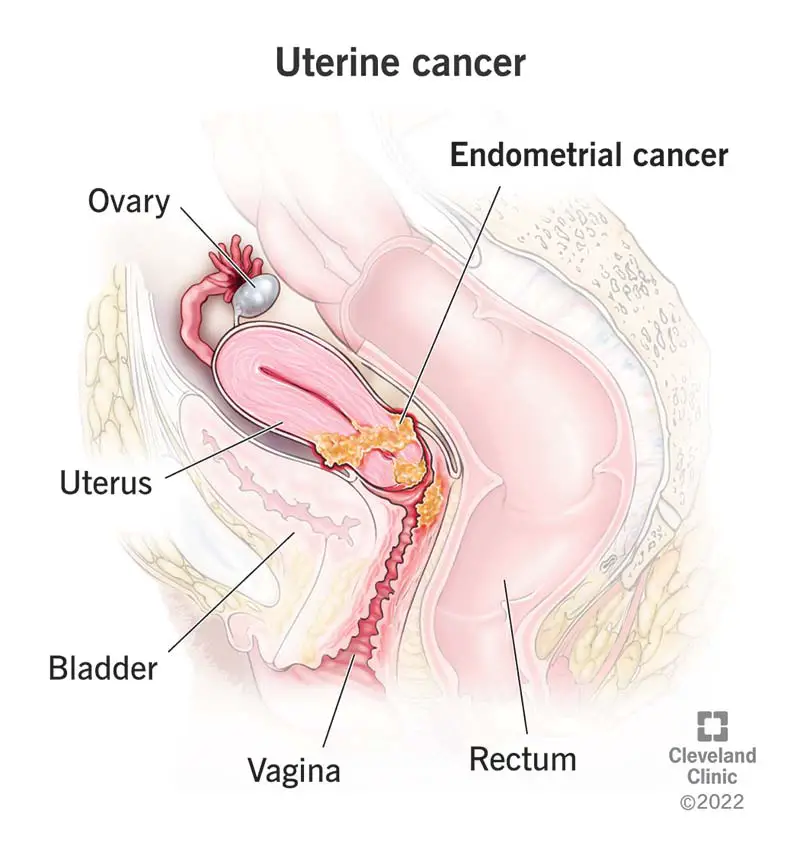 Endometrija vēzis, kas veidojas dzemdes apakšējā daļā