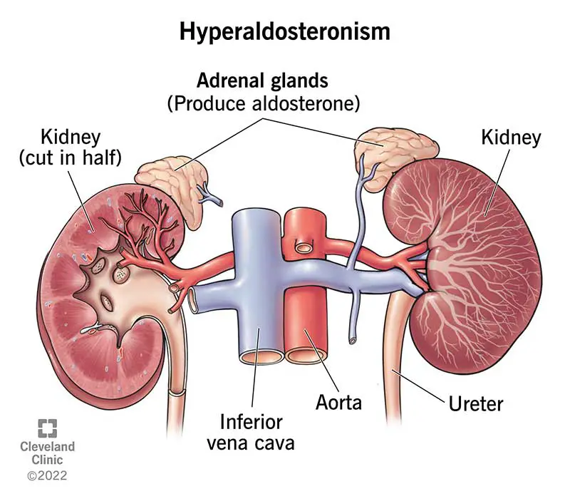 Medicīniskā ilustrācija ar divām nierēm ar vienu trīsstūra formas virsnieru virsnieru virs katras no tām.