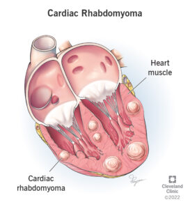 1706747850 22499 cardiac rhabdomyoma