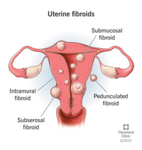 1706761537 9130 uterine fibroids