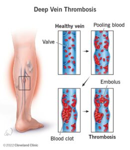 1706766091 16911 deep vein thrombosis