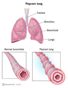 1706820860 22590 popcorn lung