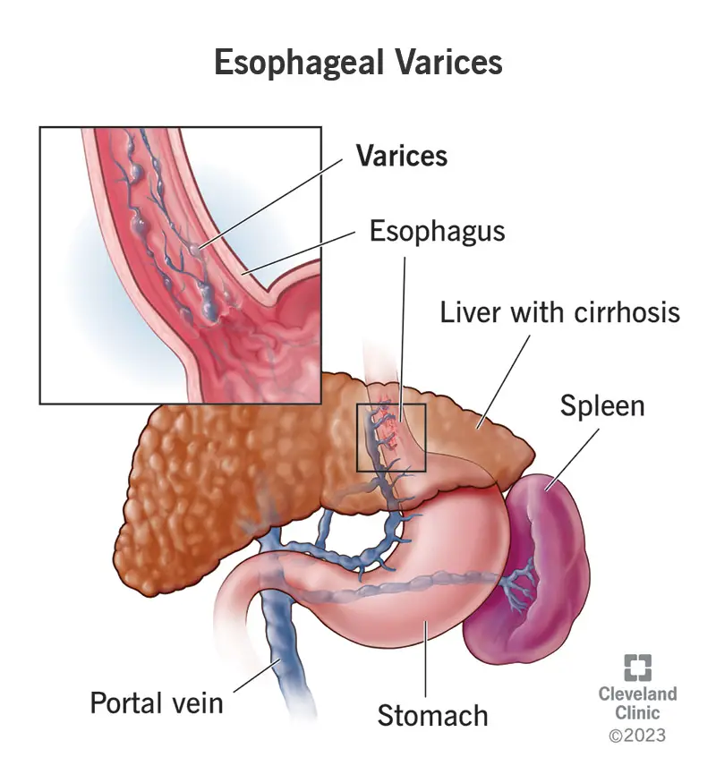 1706825482 15429 esophageal varices