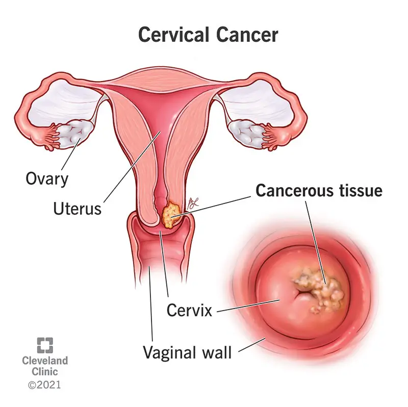 1706921535 12216 cervical cancer