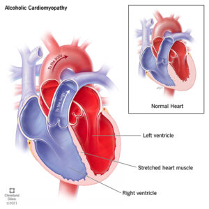 1706976258 21994 alcoholic cardiomyopathy illustration