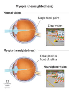 1706999116 myopia nearsightedness