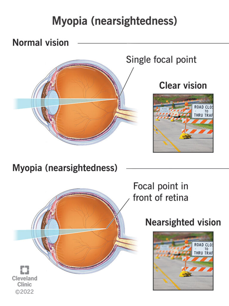 1706999116 myopia nearsightedness