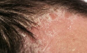 1707012855 25047 facial psoriasis