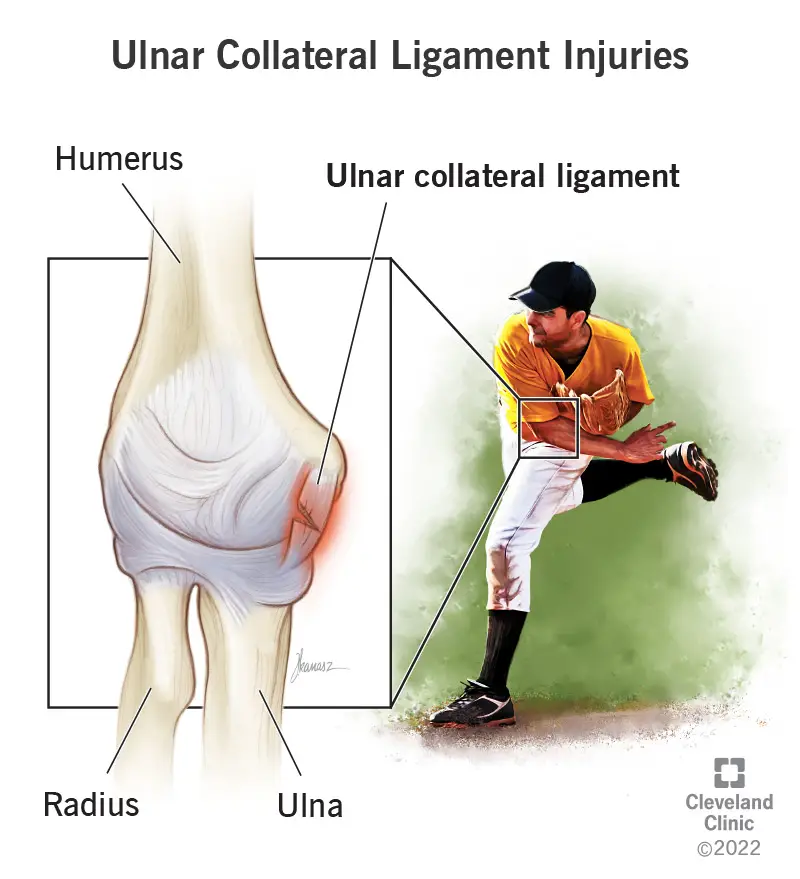 1707021975 22760 ulnar collateral ligament injuries