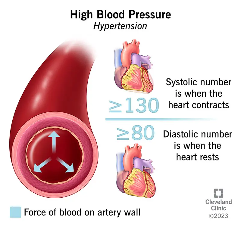 1707040218 4314 high blood pressure illustration