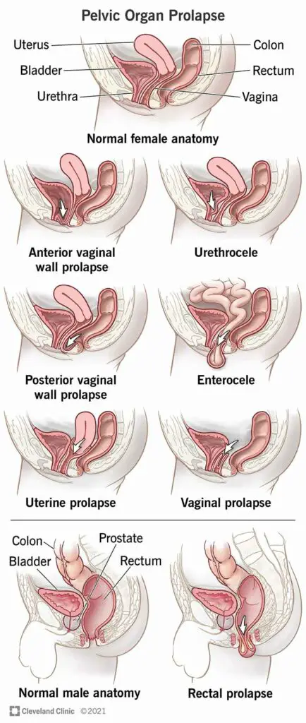 1707081319 24046 pelvic organ prolapse