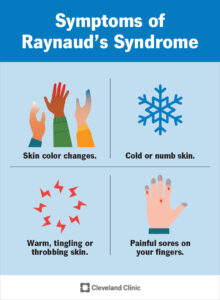 1707145452 9849 raynauds syndrome