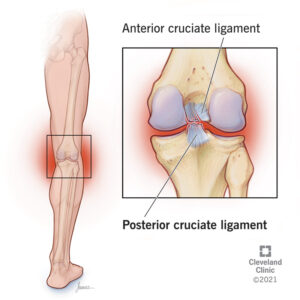 1707159086 21793 posterior cruciate ligament tear