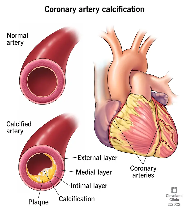 1707190998 22953 coronary artery calcification