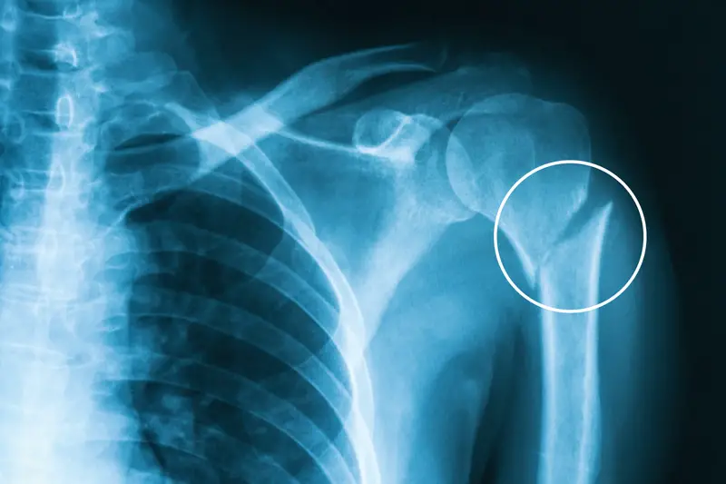 1707309677 22990 humerus fracture