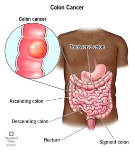 1707378260 14501 colorectal cancer