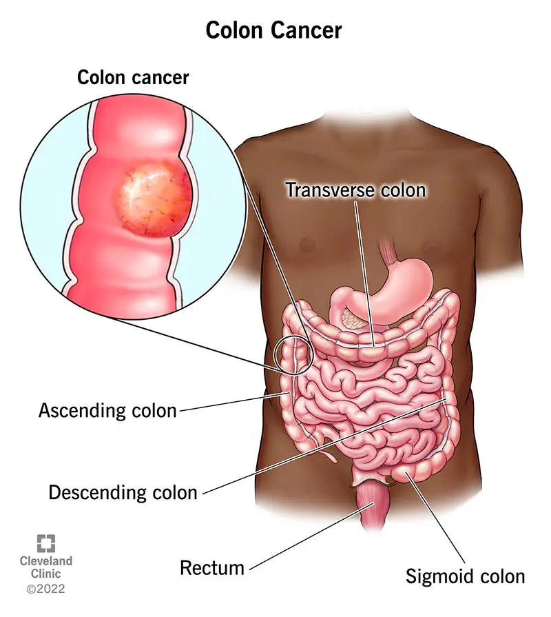 1707378260 14501 colorectal cancer