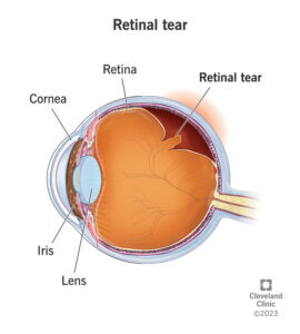 1707410174 25107 retinal tear