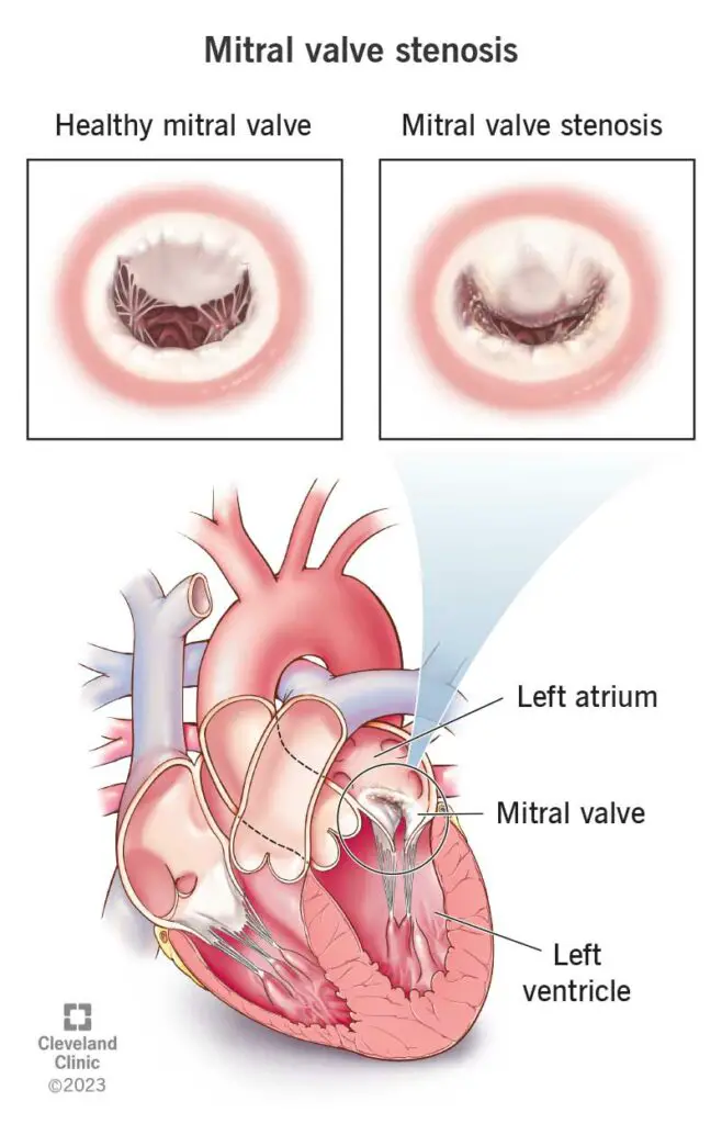 1707414737 21903 mitral valve stenosis