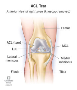 1707428476 16576 acl tear