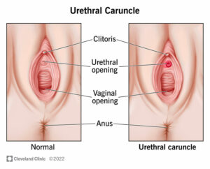 1707483314 22621 urethral caruncle