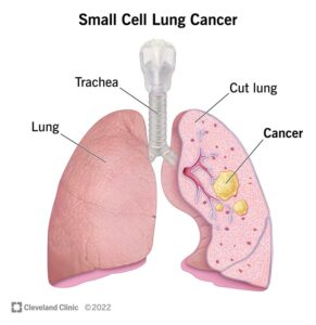 1707624794 6202 small cell lung cancer