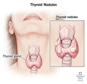 1707638473 13121 thyroid nodules illustration