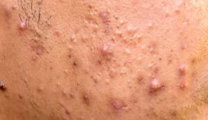 1707652153 22905 acne papules