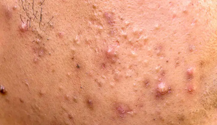 1707652153 22905 acne papules