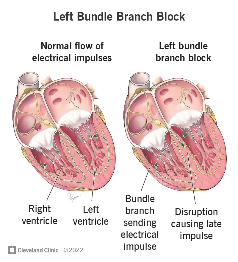 1707675141 23287 left bundle branch block