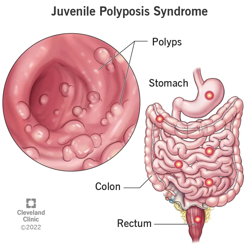 1707688825 juvenile polyposis syndrome