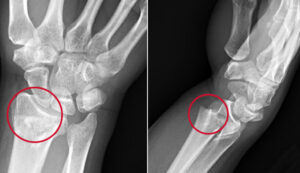 1707739343 21860 colles fracture fnl