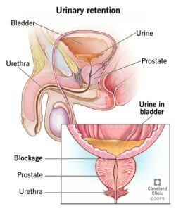 1707762260 15427 urinary retention