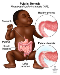 1707771437 4524 pyloric stenosis