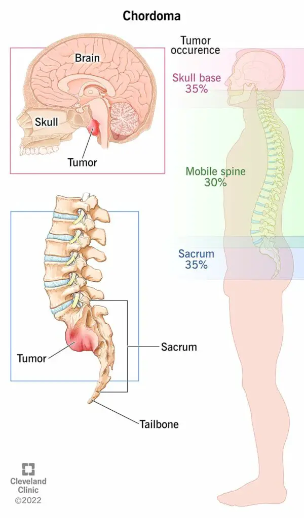 1707780561 17916 chordoma