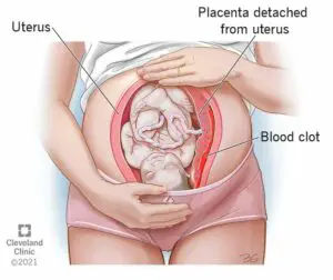 1707936138 9435 placental abruption