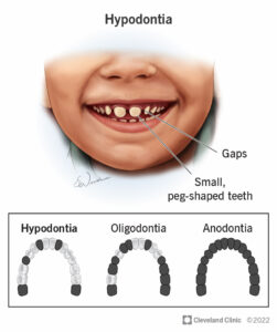 1707949814 24192 hypodontia