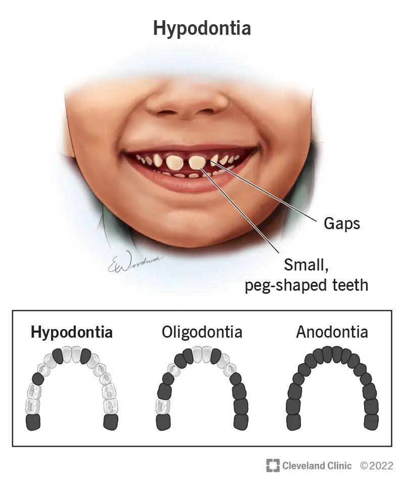 1707949814 24192 hypodontia