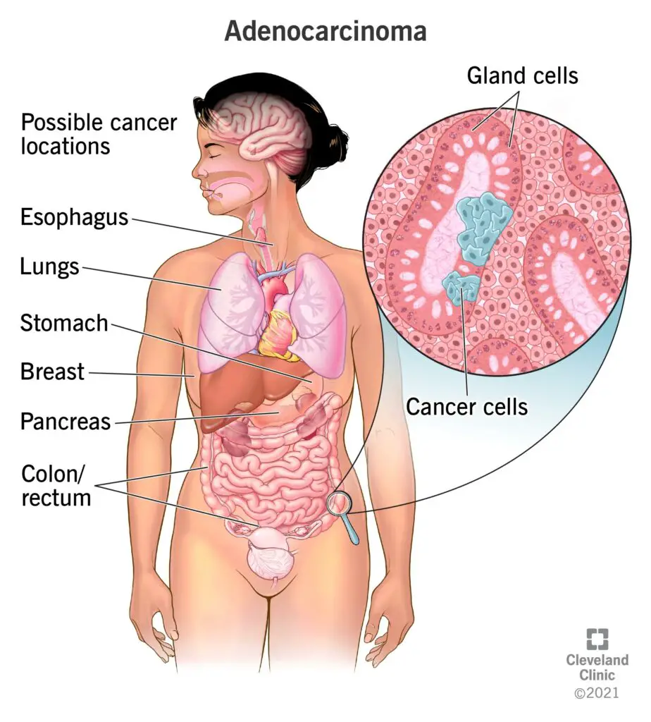 1707968064 23180 carcinoma