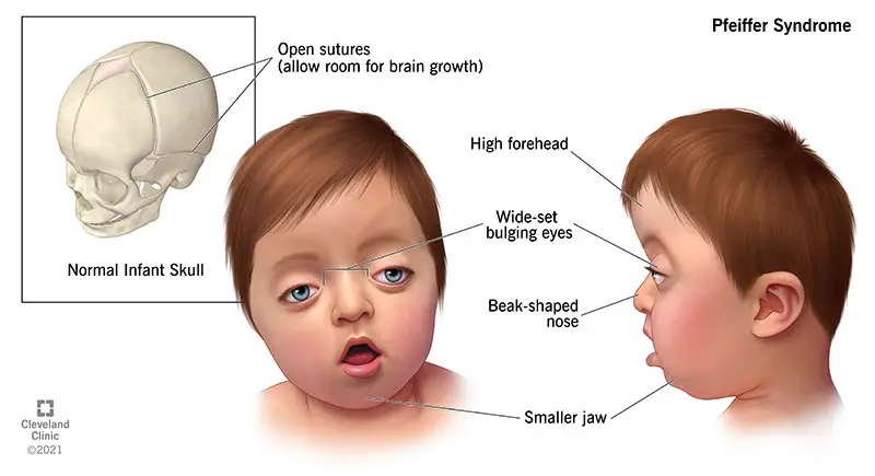 1708013661 25125 pfeiffer syndrome