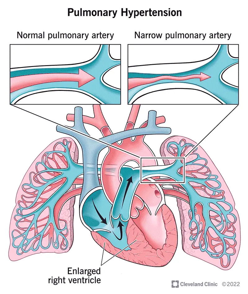 1708178483 6530 pulmonary hypertension