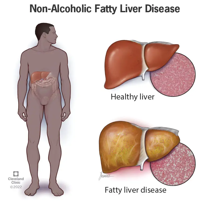 1708233312 22437 non alcoholic fatty liver disease