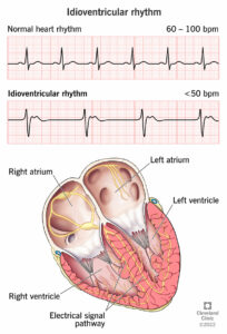 1708256113 23070 idioventricular rhythm